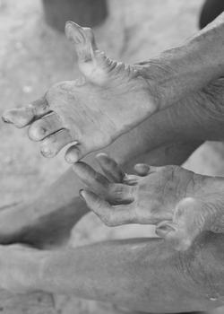 Lepra of ziekte van Hansen